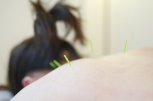 30代女性の肩こりの鍼施術中の写真