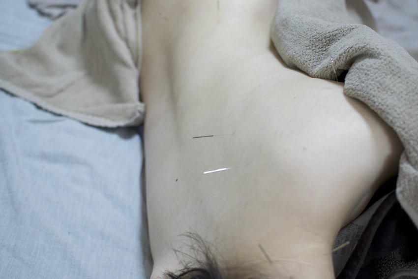 肩甲骨と肩へのマタニティ鍼治療中